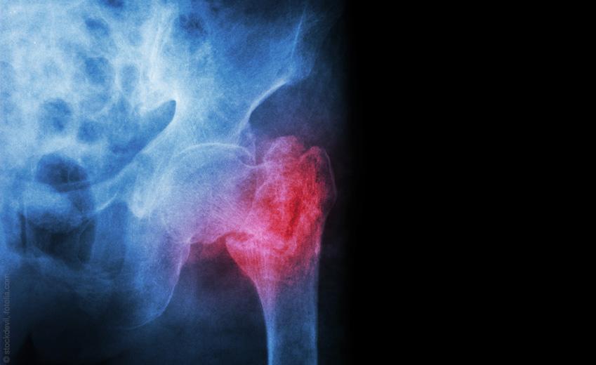 Osteoporose: Ursachen und Vorbeugung
